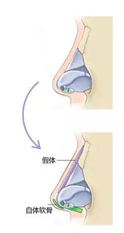 适应人群:排斥植入假体的塌鼻者、鼻子严重畸形者、反复隆鼻失败者。