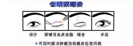 全切双眼皮