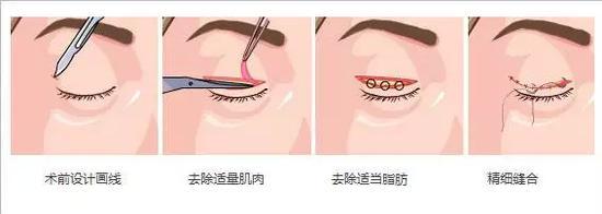 切开双眼皮手术