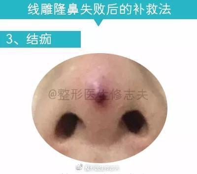 补救3