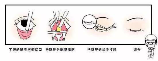 外路眶隔释放法