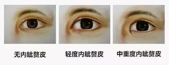 內眦