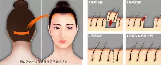 发际线过高矫正