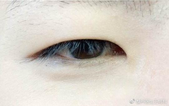 肿眼泡