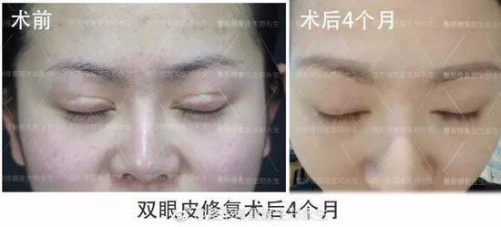 双眼皮修复