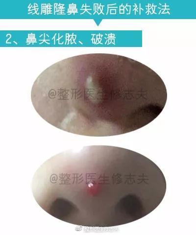 补救2