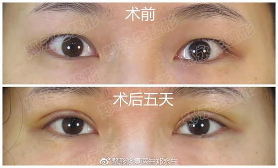 术后