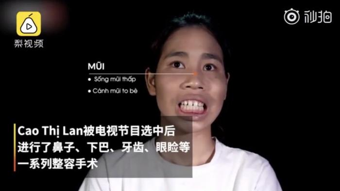 整形经过