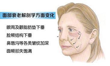 面部提升