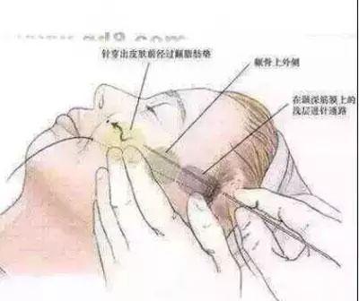 PPDO悬吊线