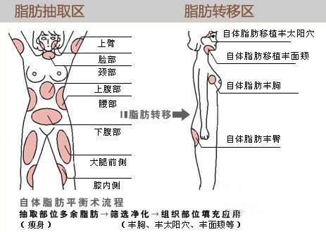 脂肪移植