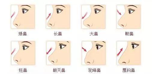 鼻综合