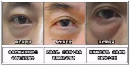 脂肪