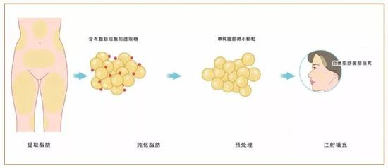 自体脂肪移植丰额头