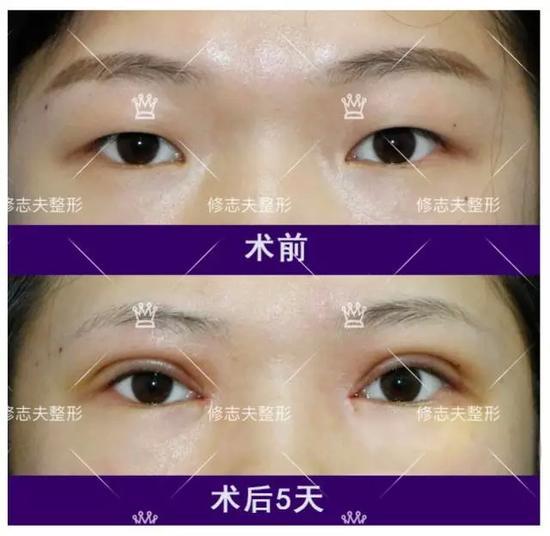 切开法双眼皮+开眼角术前术后