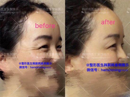 去除鱼尾纹