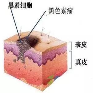 虽然表面看上去也是一个小黑点,但黑素瘤可比普通的痣凶险多了……