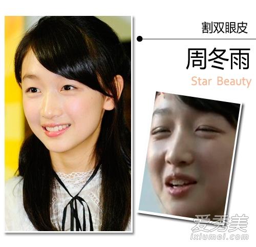 疑似整形手术:割双眼皮