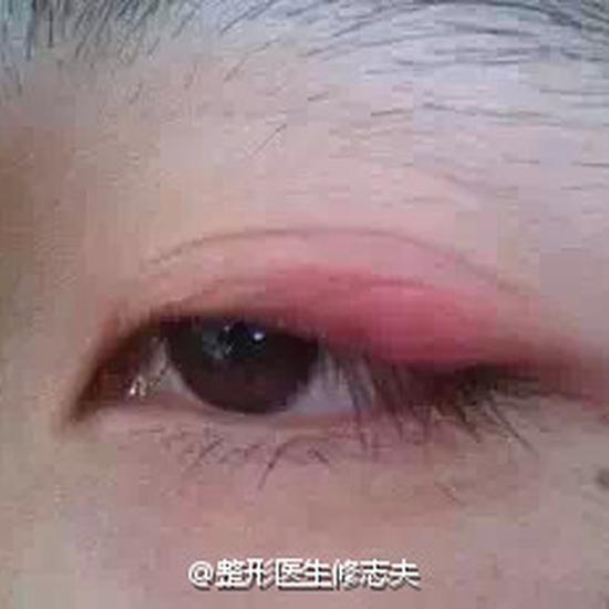 眼皮发炎
