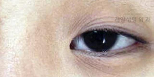 眼皮松弛了