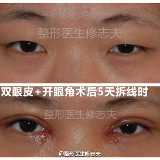内眼角开大