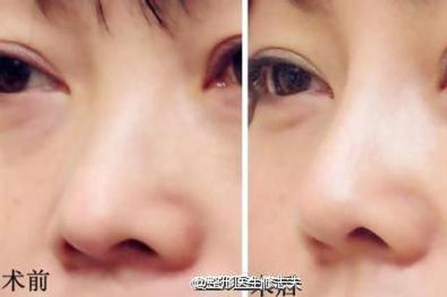 隆鼻手术,可以使眼距在视觉上显得更近一些,改善这种状况。