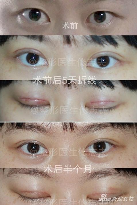 还在恢复期,没有完全恢复
