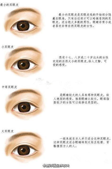 双眼皮过宽