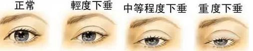 上睑下垂分级
