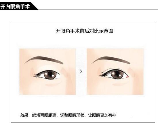 开内眼角手术