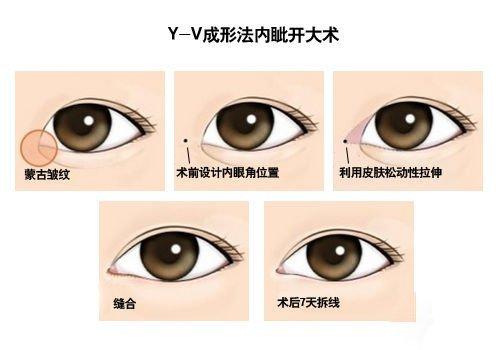 Y-V成形法