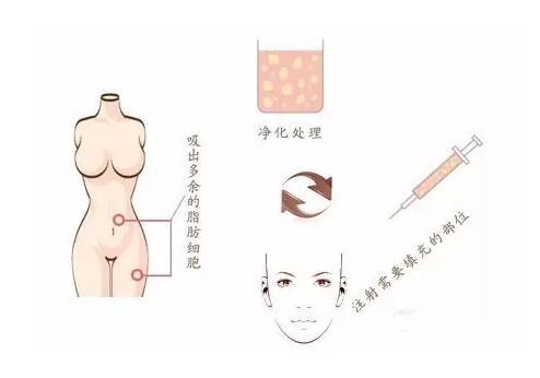 自体脂肪移植
