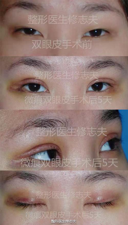 微痕双眼皮手术案例