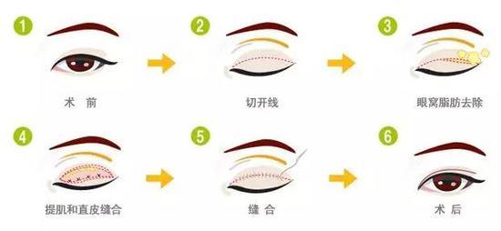 切开法双眼皮示意图