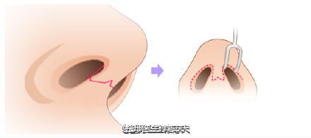 鼻综合整形