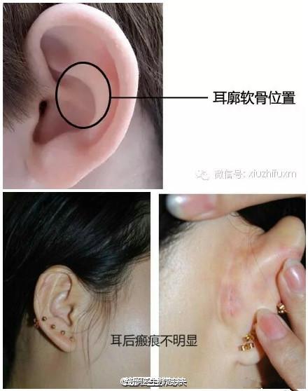 取耳软骨