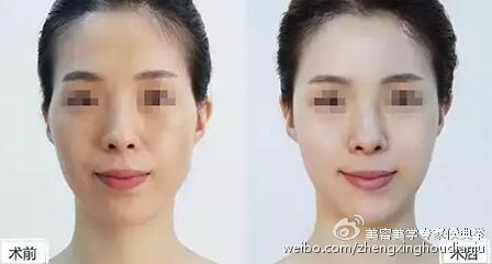 瘦脸针效果图