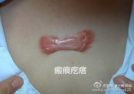 瘢痕疙瘩