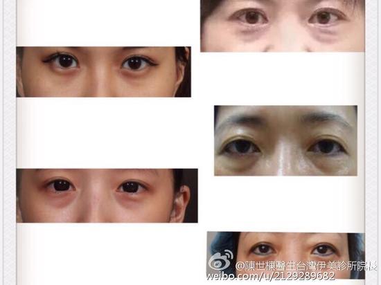眼下老化