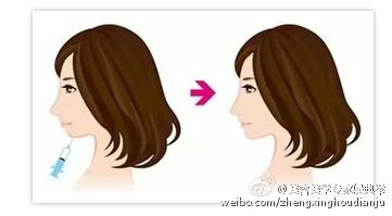 玻尿酸丰下巴