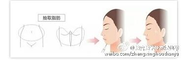 自体脂肪丰下巴