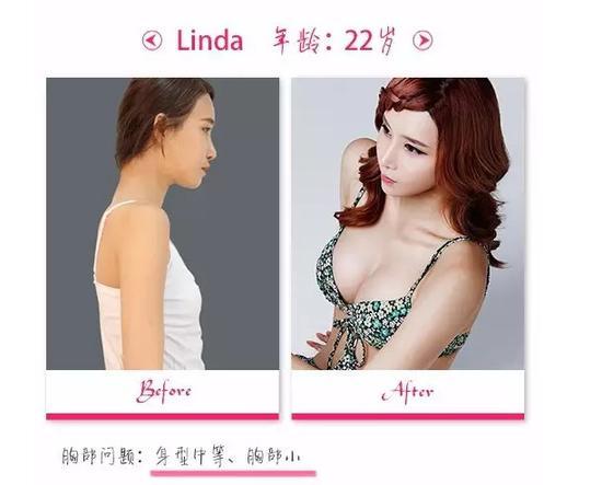 针对天生乳房扁平、不对称等问题。
