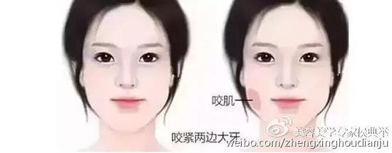 咬肌肥厚
