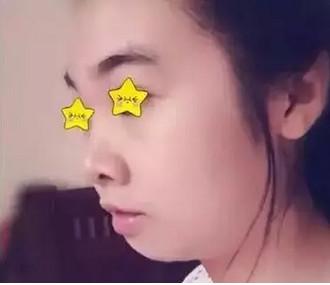 凸嘴