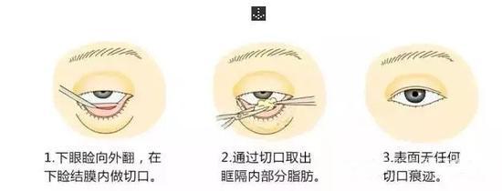 去眼袋