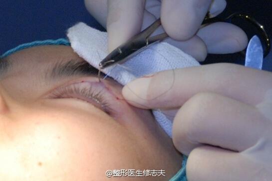 埋线双眼皮术进行中