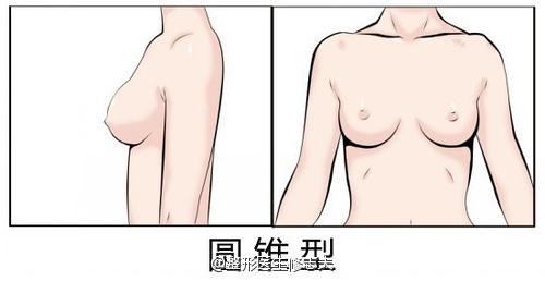 圆锥型