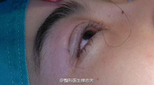 缝合后的睁眼效果
