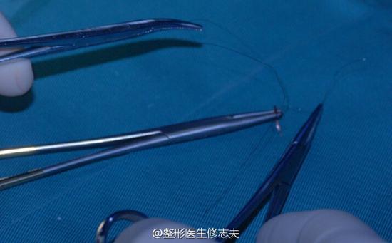 缝合双眼皮用到的线