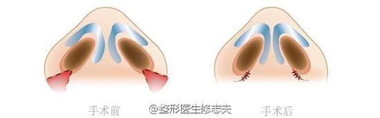 缩小鼻孔
